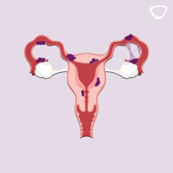 Das Foto zeigt eine nachdenkliche Frau. Die Diagnose Endometriose kann vor allem für Frauen belastend sein.
