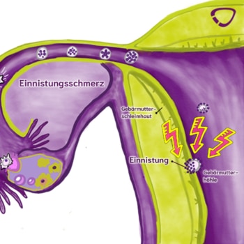 Einnistungsschmerz findet beim Andocken der Eizelle in der Gebärmutter statt.