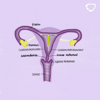 Die Hormonspirale wird in die Gebärmutter eingesetzt.